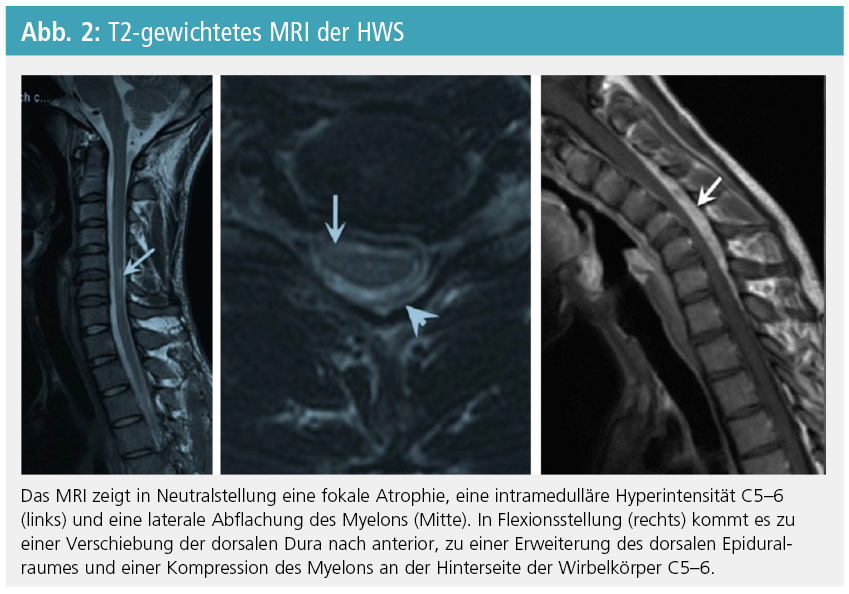 HirayamaErkrankung seltene Form einer Motoneuronerkrankung